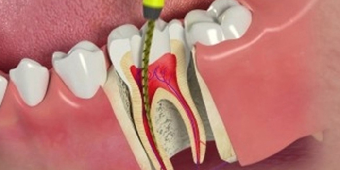 root-canal-tretment