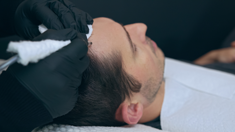 GFC Treatment In Hyderabad What Is Stronger Than PRP?What Is The Cost Of GFC In Hyderabad? Is GFC Treatment Permanent? Is GFC Results Permanent? Who Predicted The GFC? What Age Can You Get GFC Treatment? What Is GFC full for? How Long Does GFC Treatment Last In Hyderabad Does Hair Fall Again After PRP Treatment? How Much Does GFC Hair Treatment Cost In Hyderabad?