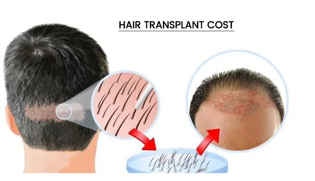 Hair Transplant Cost In Hyderabad